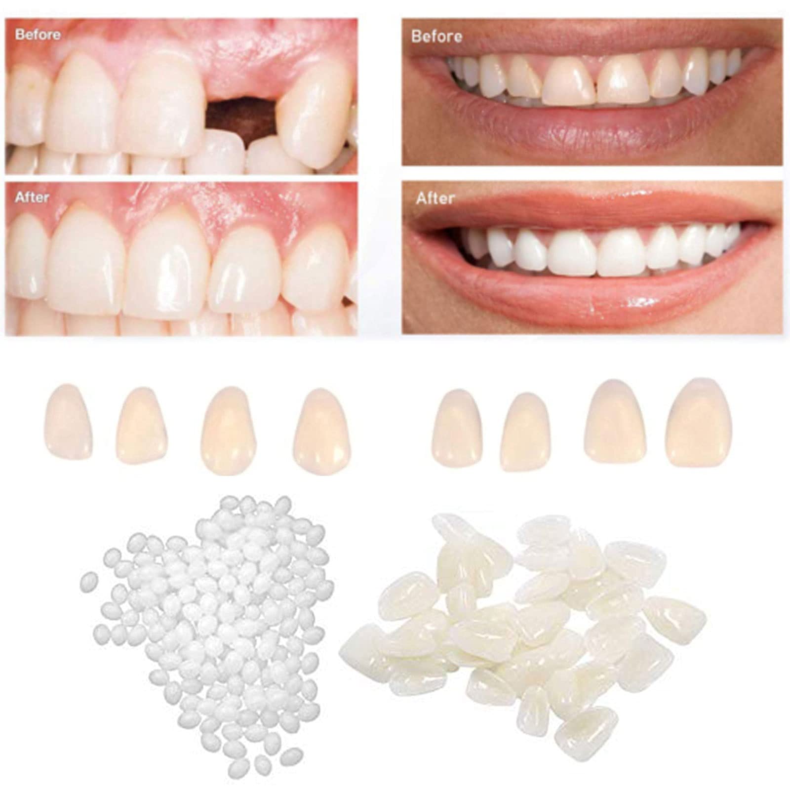 Temporary Teeth Repair Kit,Tooth Repair Kit for Kenya