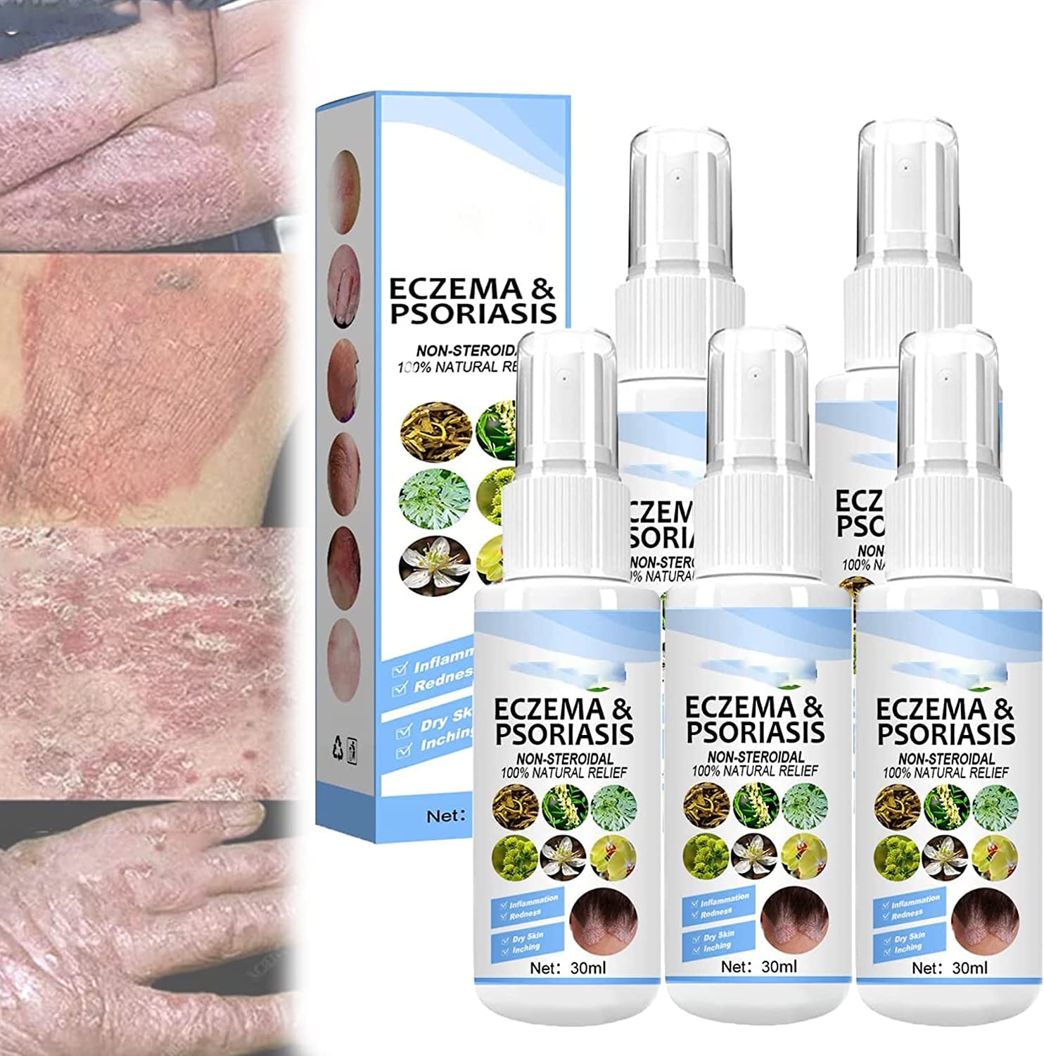 Title: BEESO Melllop Herbal Psoriasis Relief Spray - 5pcs Pack for ...