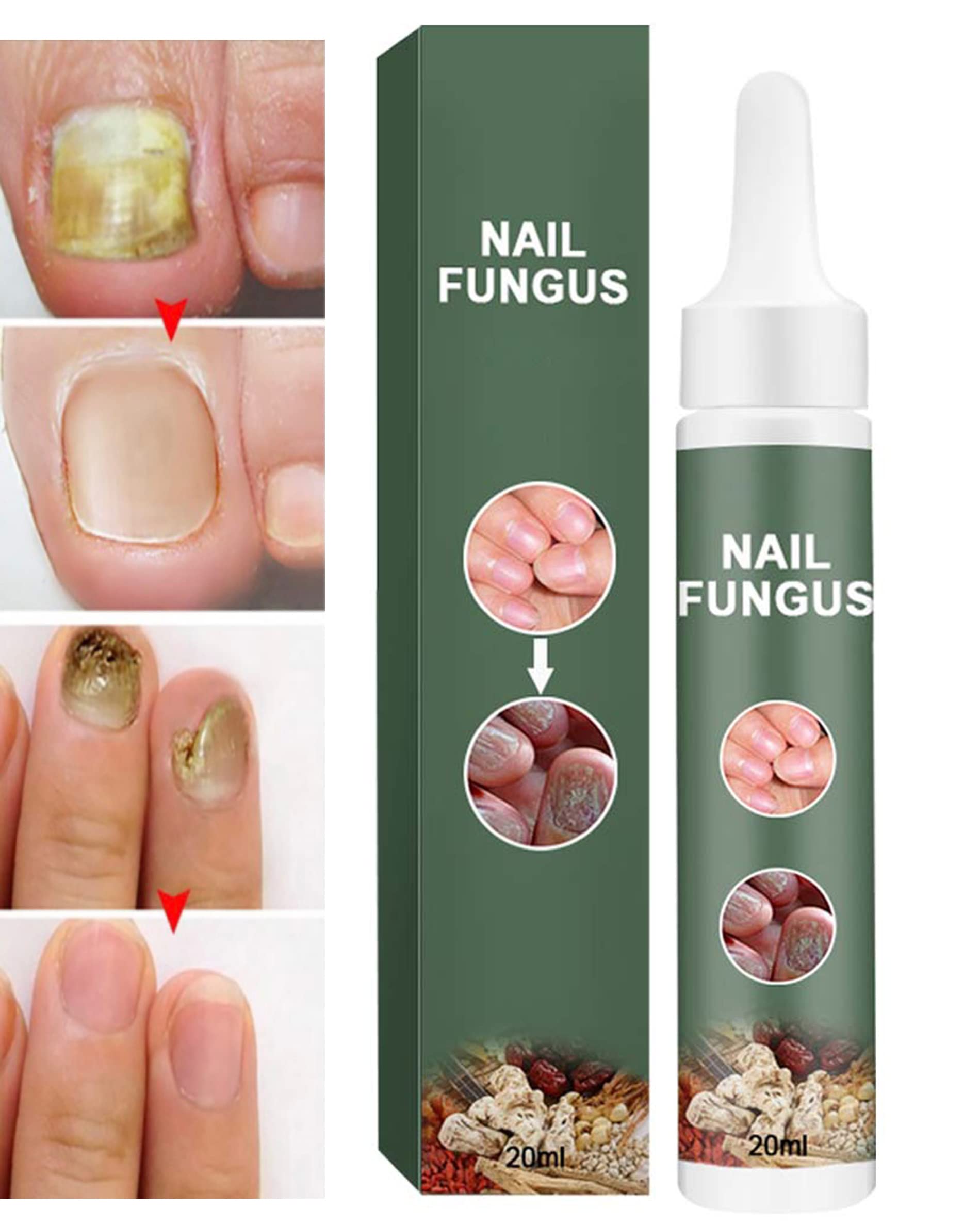 Toenail Fungus treatment