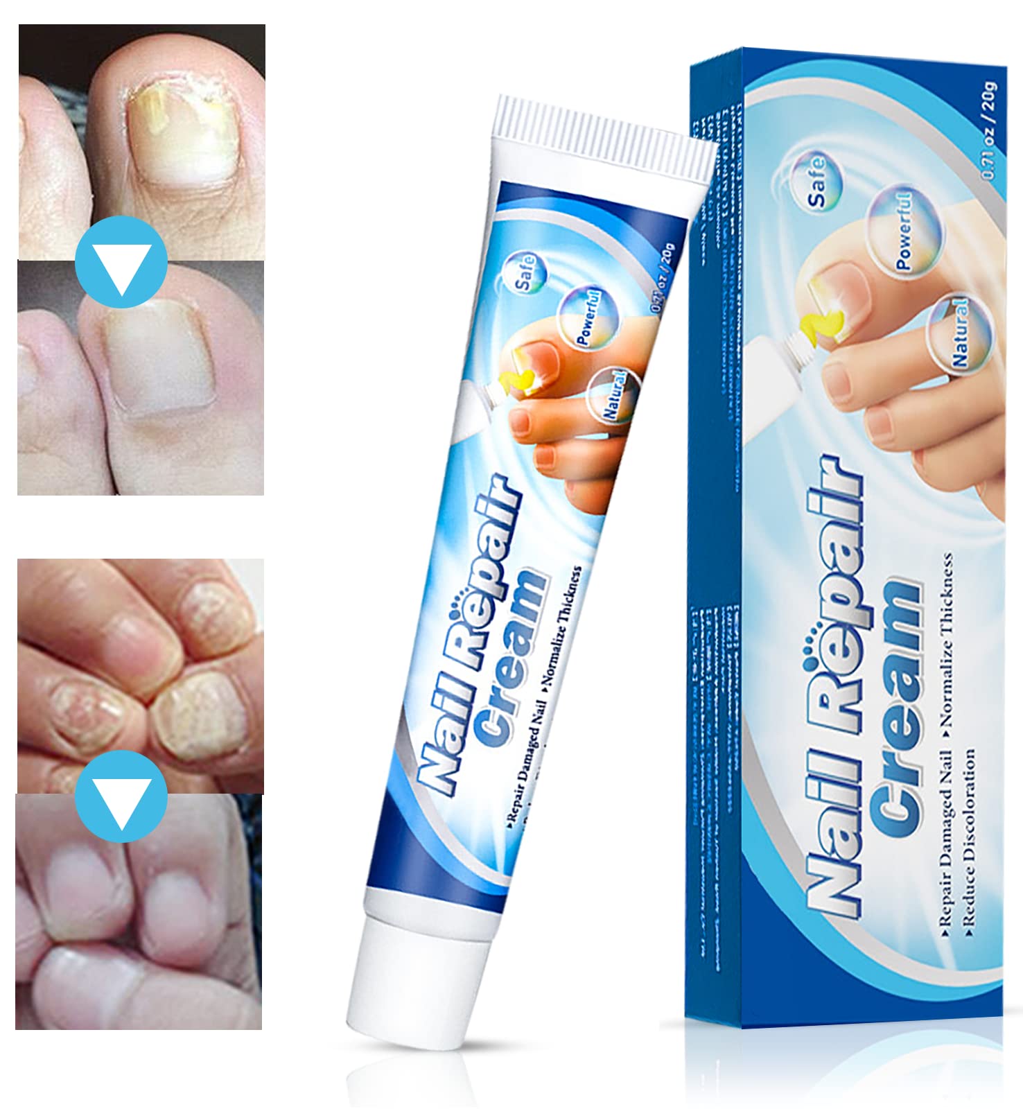 Anti Fungal Treatment Nail Ointment, Onychomycosis Paronychia Infection  Herbal Toe Finger Nails Health Nail Fungus Treatment, Non-toxic -  Walmart.com