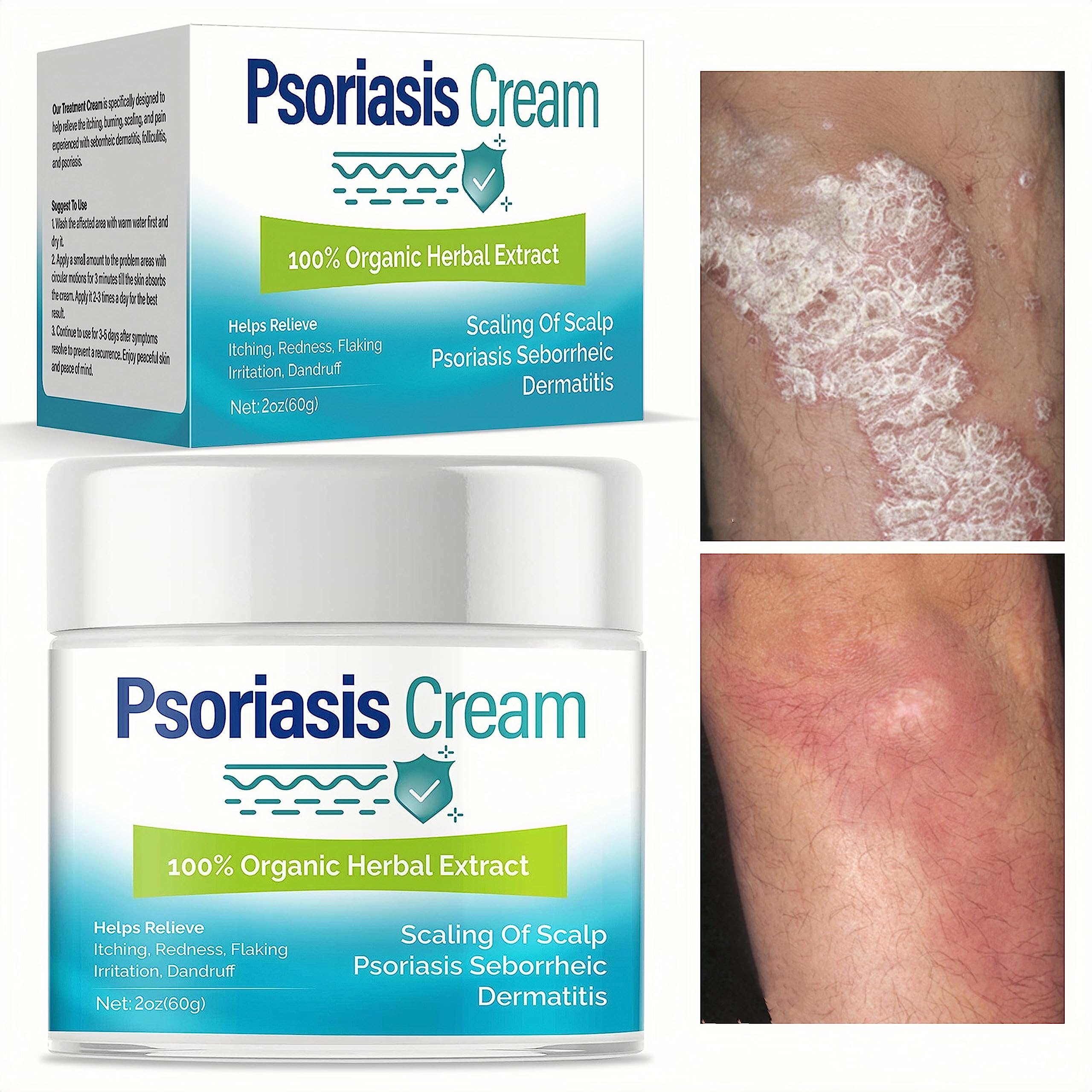 ITecFreely Psoriasis Cream Fast Effective Scalp Treatment For Dry 