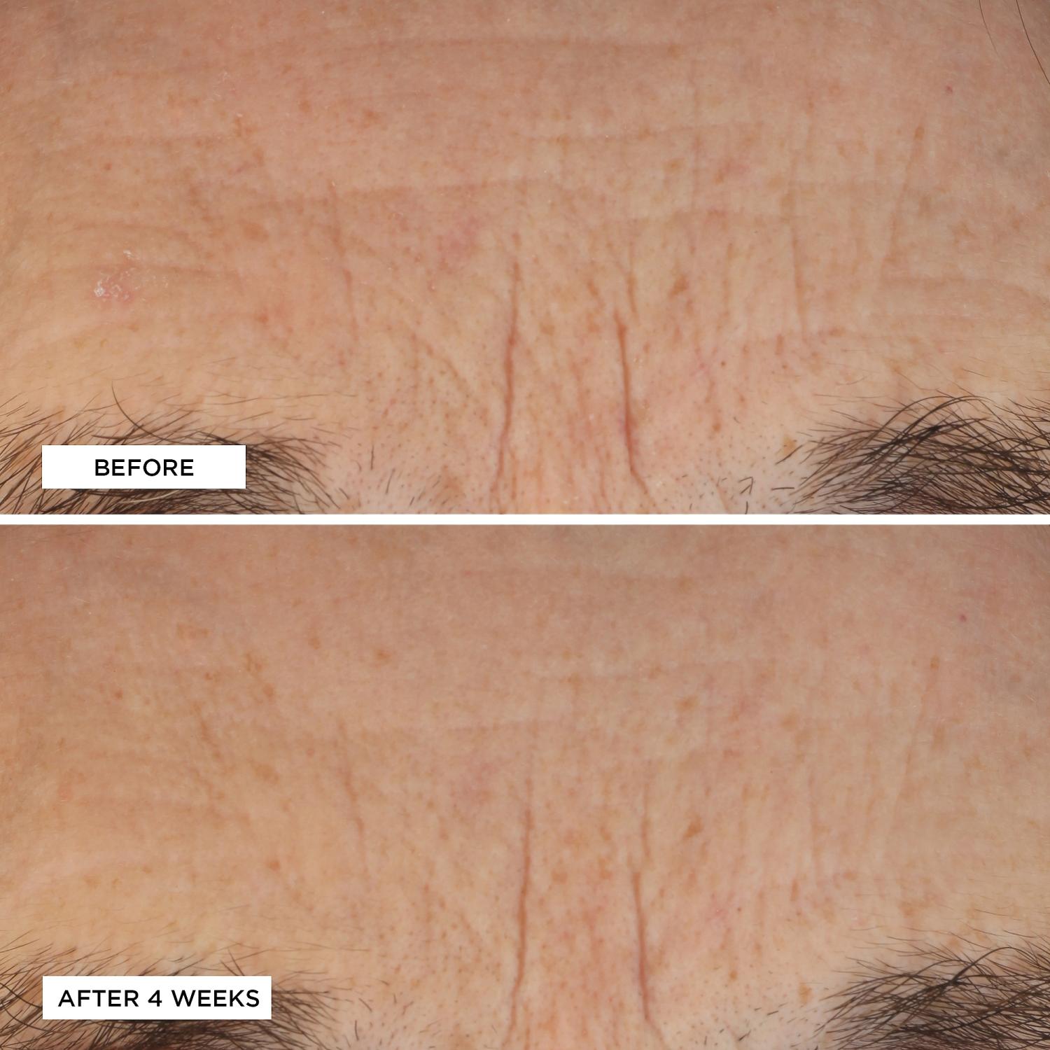 perricone md acyl glutathione deep crease serum reviews APR-246 induces early cell death by ferroptosis in acute myeloid leukemia main image 0