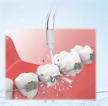 VINFANY Orthodontic Tips - Thumbnail 4
