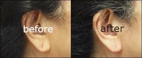  Miracle Stretched earlobe Corrector shrinking oil fix