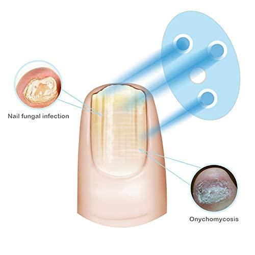 Highly Effective Rechargeable Nail Fungus Laser Treatment Device Nail ...