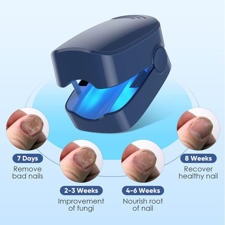 Nail Fungus Laser Treatment Device, Fungus Laser Cleaning Device for Fingernails and Toenails
