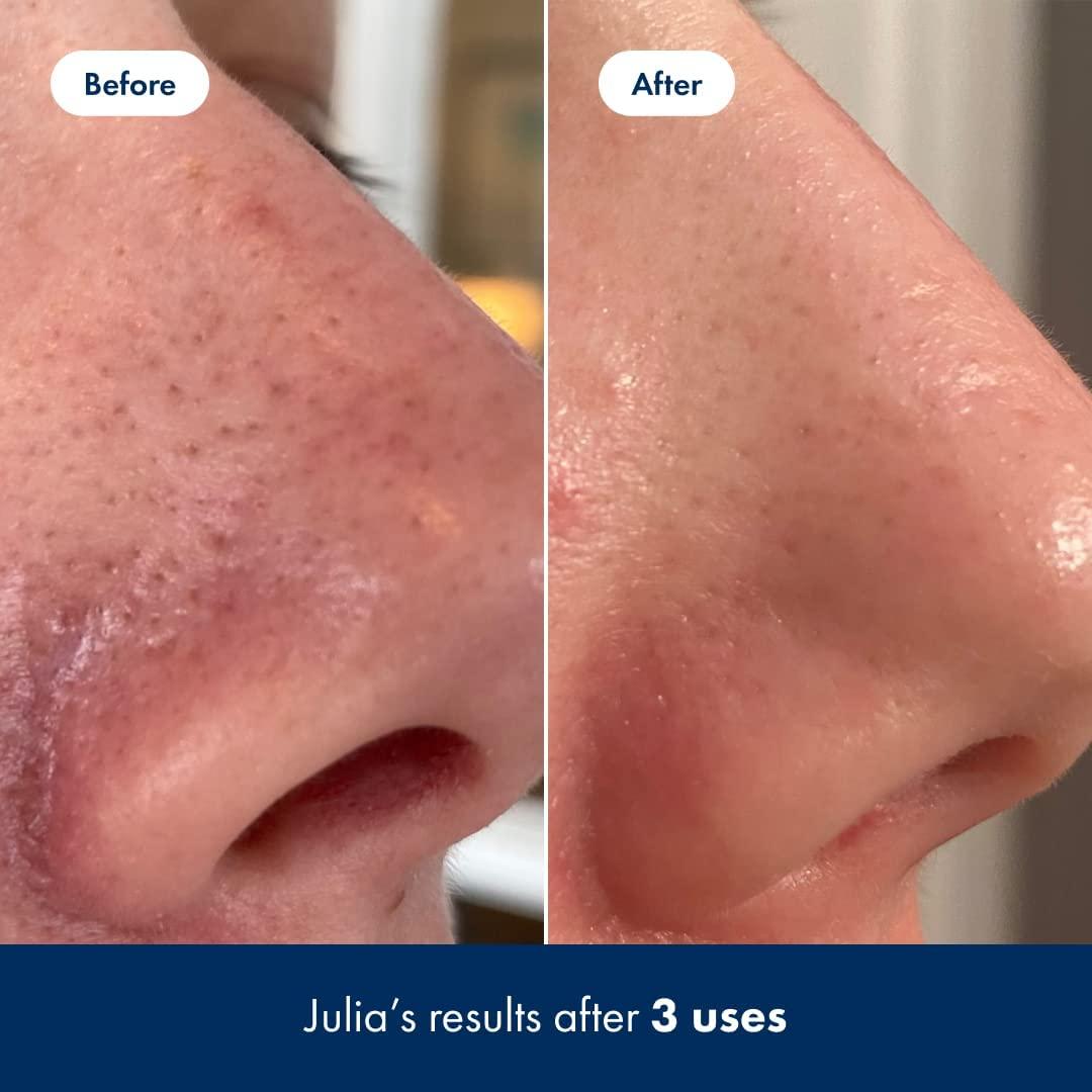 Hero Cosmetics Pore Release Blackhead Clearing Solution Exfoliating Toner Featuring BHA, PHA