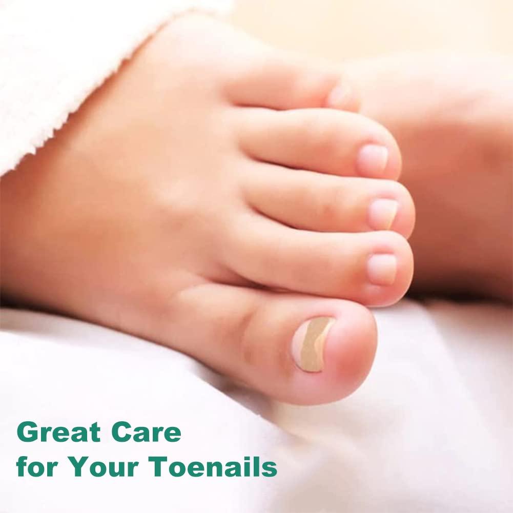 Ingrown toenails - treatment, symptoms, causes and prevention | healthdirect