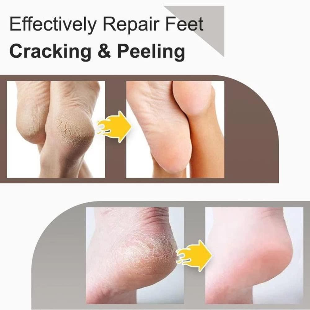 Painful Cracked Heels and Split Fingers: How to Treat Them Effectively -  SkinIntegra