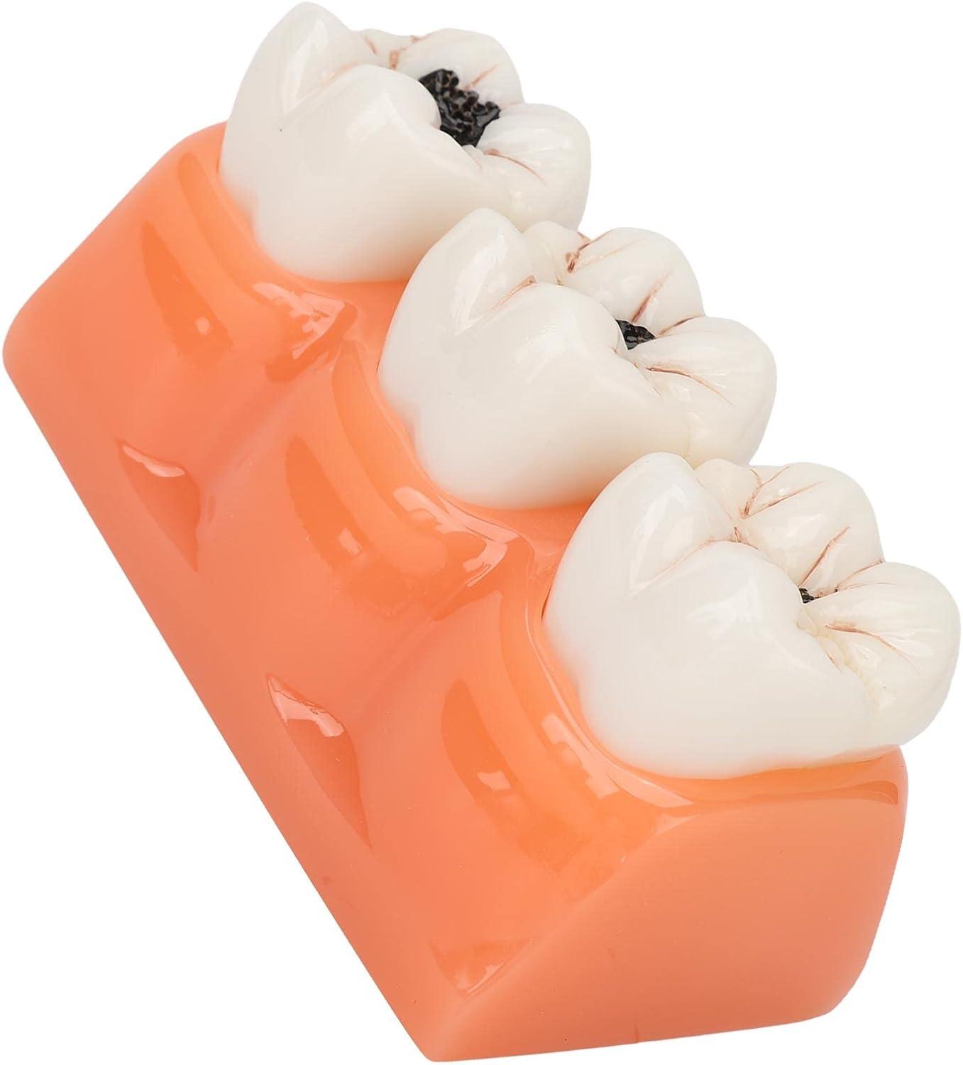 4-Fold Dental Caries Model - Synthetic Resin Oral Care Training Tool ...