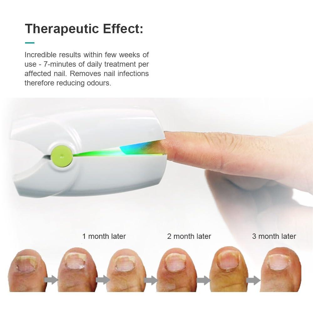 Nail Fungus Laser Treatment LED Light Device Effective Convenient Nail Fungus Treatment for