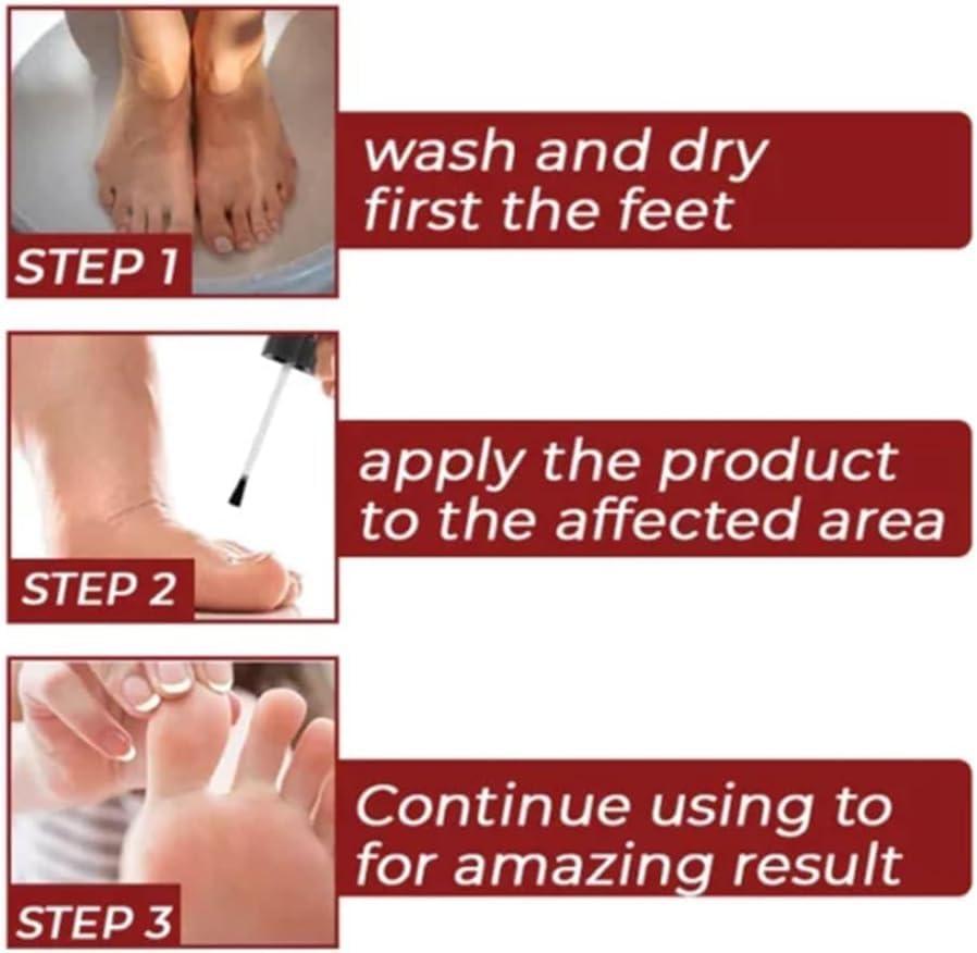 DENERASS GFOUK Foot Corn Removal Extra Strengthen Gel Corn Removal