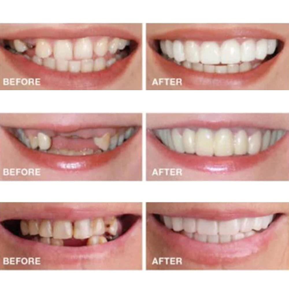 Teeth Brace Cover Instant Smile Teeth Veneers Beautiful Smile Dentures