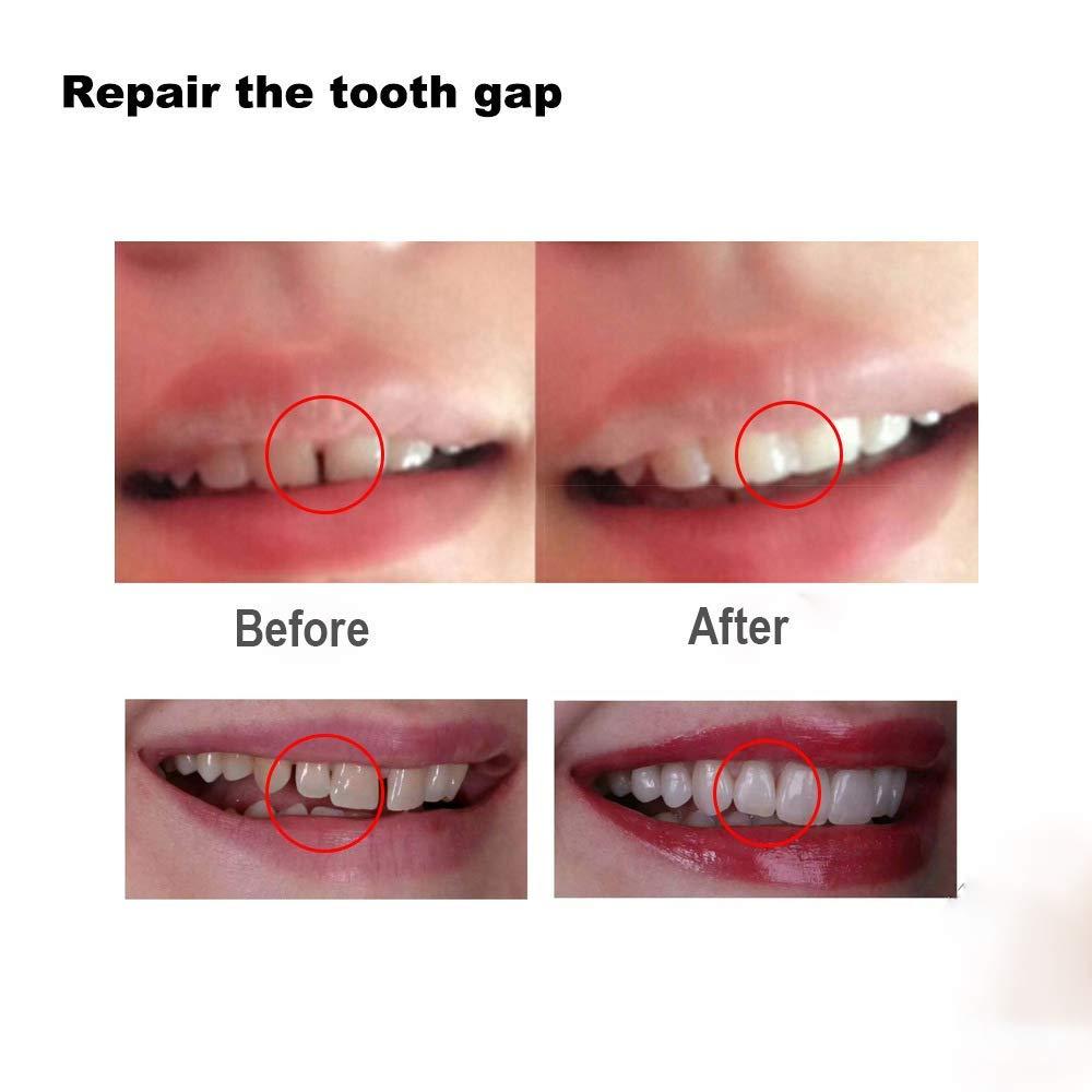 DIY Tooth Filling Thermal Beads Temporary Moldable False Teeth Kit (2 pack)