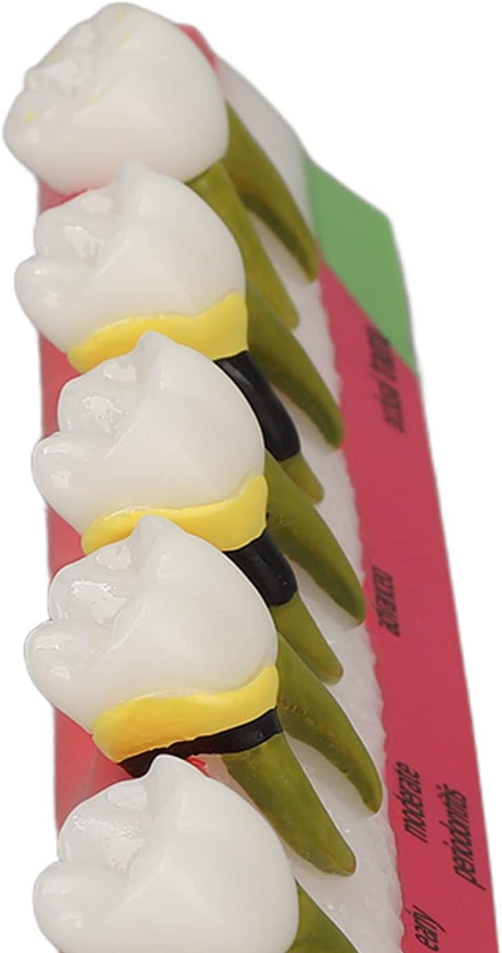 Realistic Dental Periodontitis Model - Study Dental Teeth in Various ...