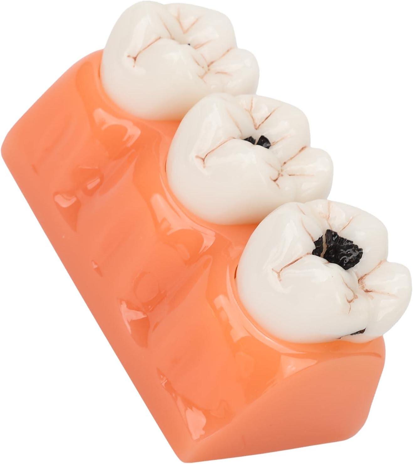 4-Fold Dental Caries Model - Synthetic Resin Oral Care Training Tool ...