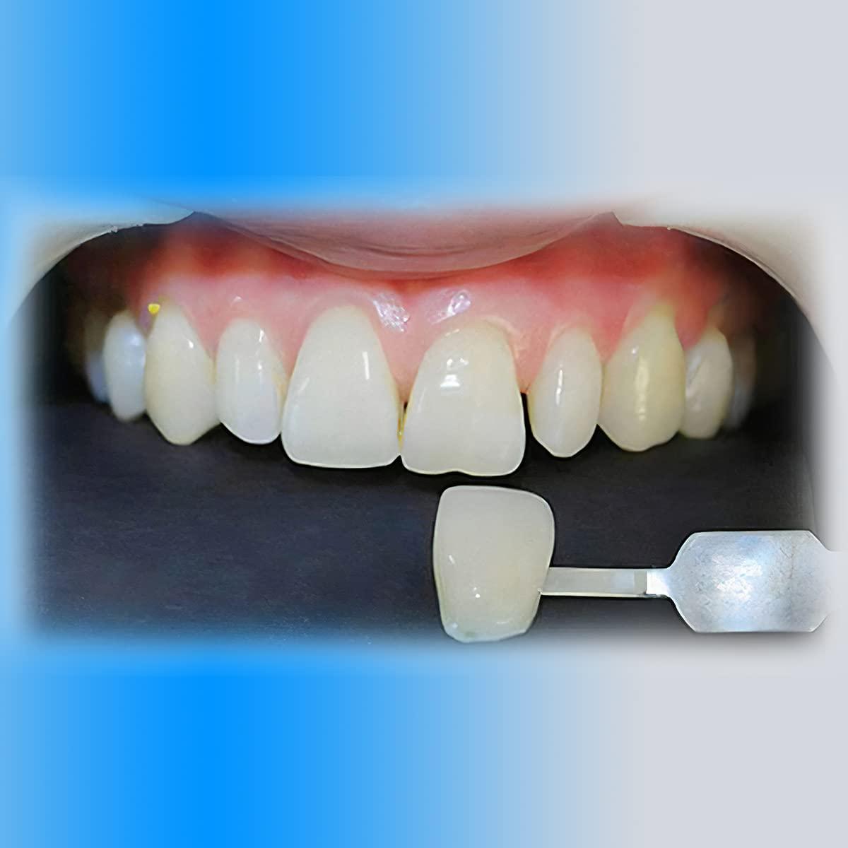 Fake Teeth Dental Resin Kit for Teeth Can Be Used for Filling Teeth Missing Teeth Teeth False