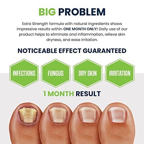 nail fungal treatment - Buy nail fungal treatment at Best Price in Malaysia  | h5.lazada.com.my