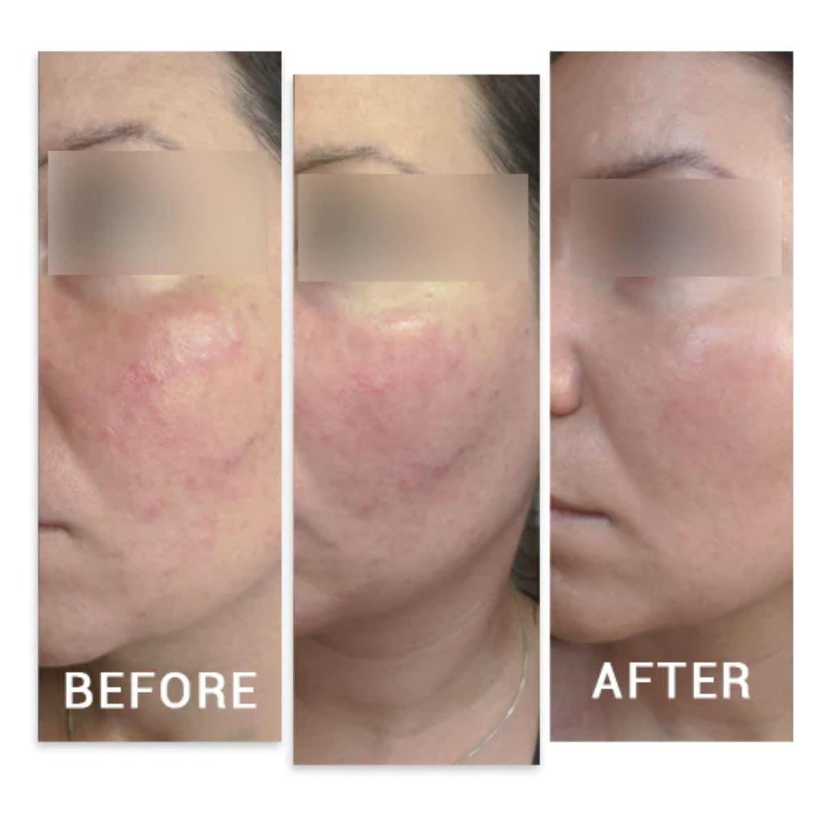 ZustBeauty 3in1 Derma Roller Kit with 0.3mm Titanium Microneedling