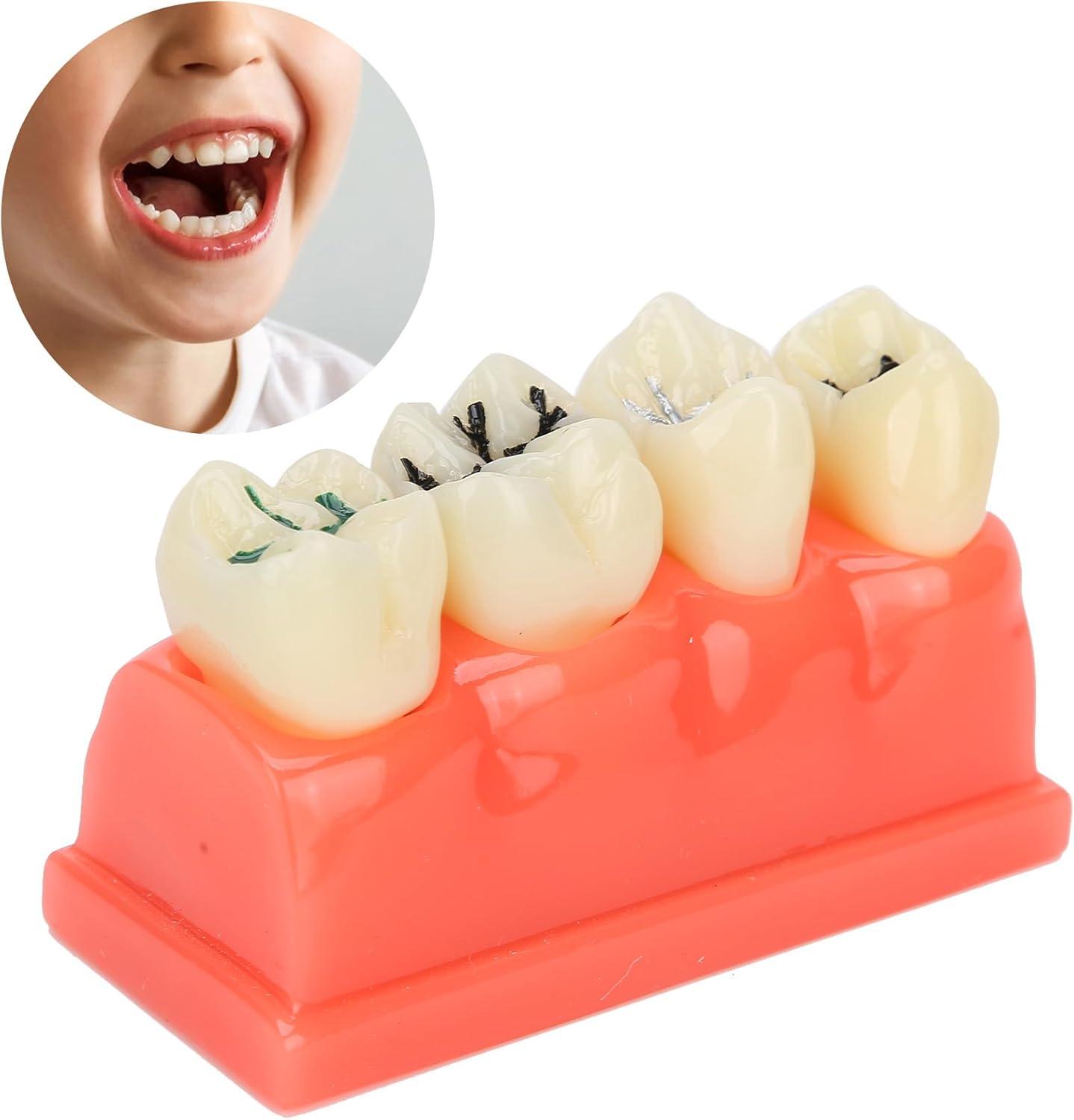 Ververt Touch Tooth Model - 180mm Dental Caries Demonstration Model for ...