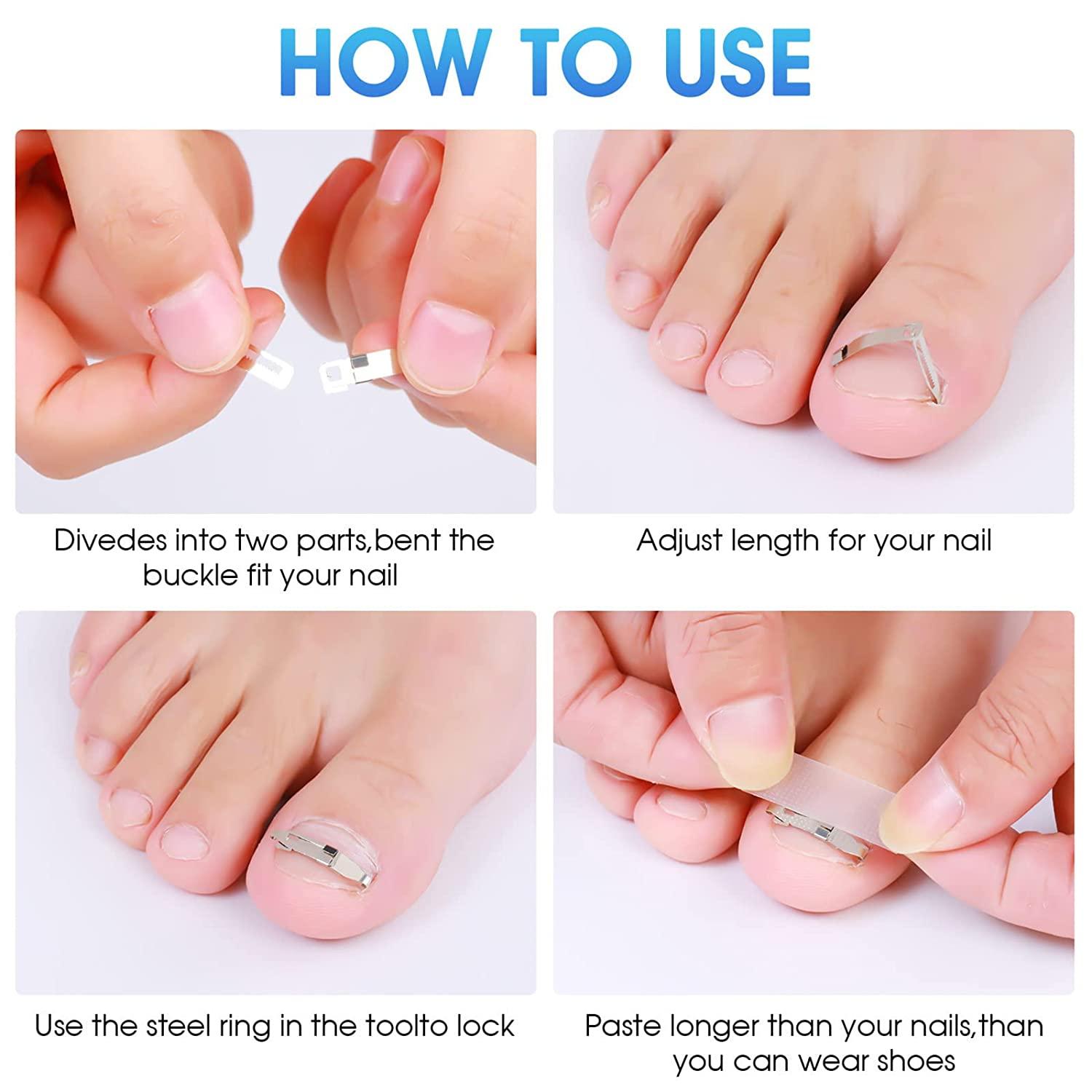 5Th Toe Nail Ingrown? The Vertical Implantation Solution You Need - tcb8vr6