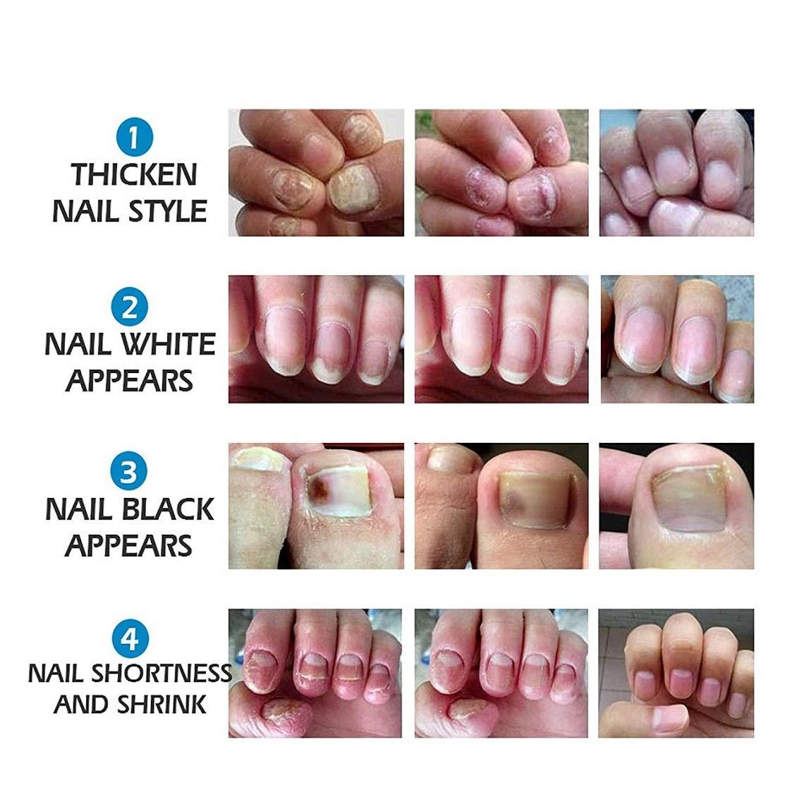 Toenail Fungus Treatment, Nail Repair Cream, Toe Nail Treatment Extra  Strength, Repairs and Renew Damaged, Broken, Cracked & Discolored Nails -  Walmart.com