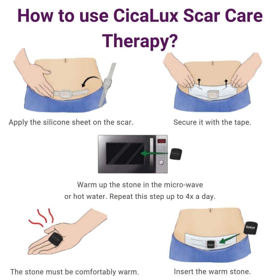 CicaLux Scar Treatment for Surgical Scars Triple Action Heat Pressure