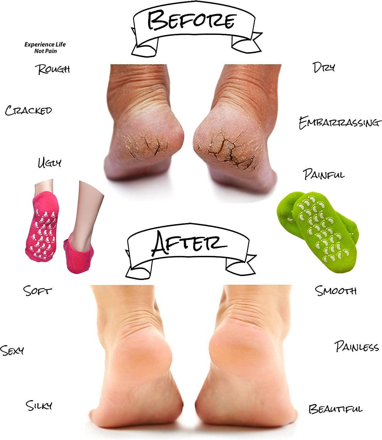 Vaincre Cracked Heel Repair Socks - 4 Pairs Moisturizing Heel Socks for Dry Cracked  Feet, Gel Socks for Cracked Feet Heel Treatment, Spa Moisture Cracked Heel  Socks for Dry Heels Overnight (Regular)