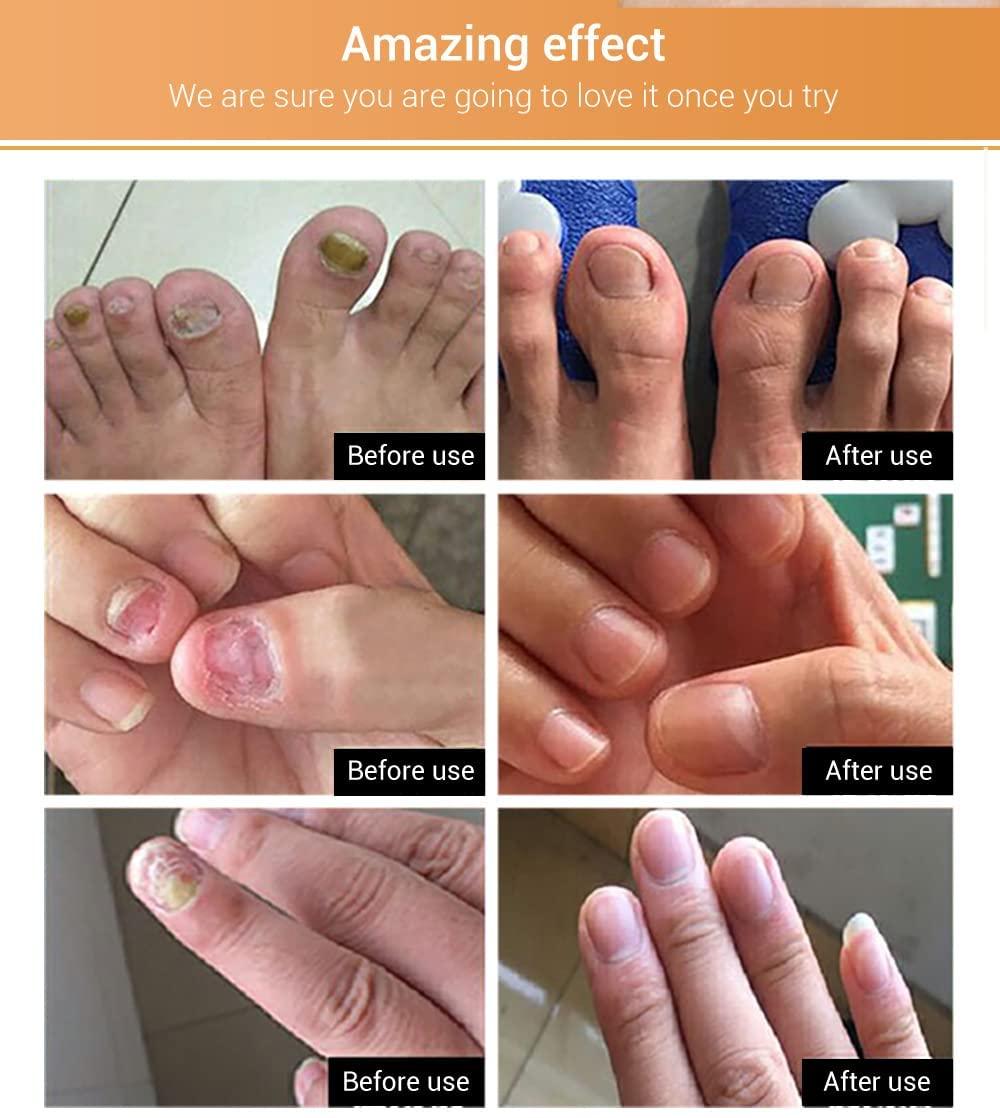 Innovative Treatments for Nail Fungus using Compounded Medications |  Bayview Blog