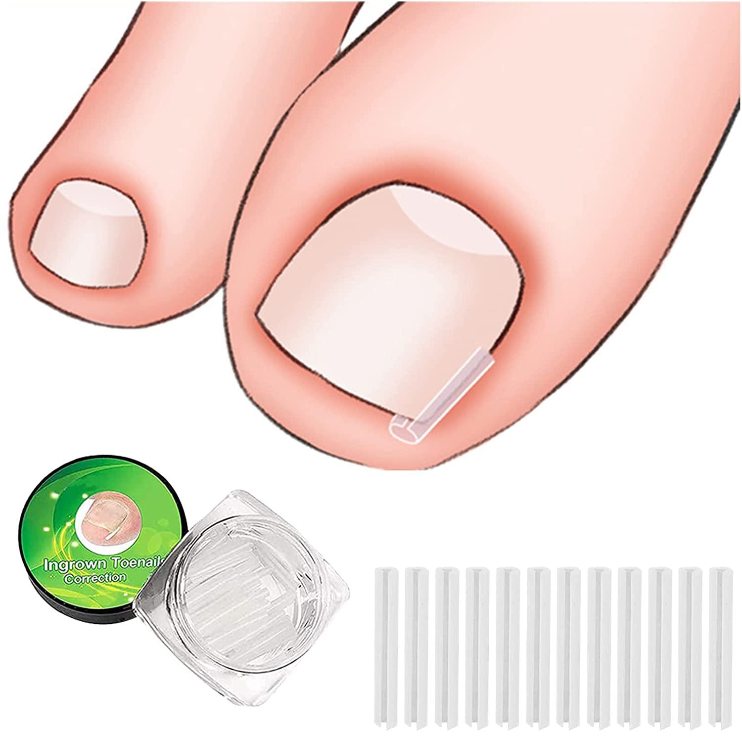 (30+2) Pack Ingrown Toenail Correction Treatment Kit, 30PCS Ingrown