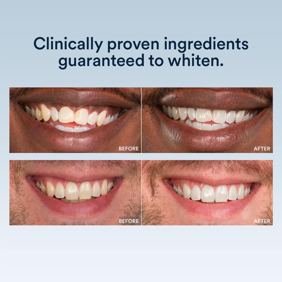 Auraglow Teeth Whitening Strips 28 Strips Enamel Safe, 14 Day Treatment with Hydrogen Peroxide