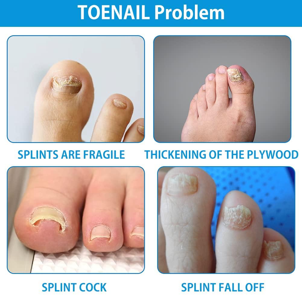 Nail Repair Cream Effective Toenail Fungus Treatment Cream Extra