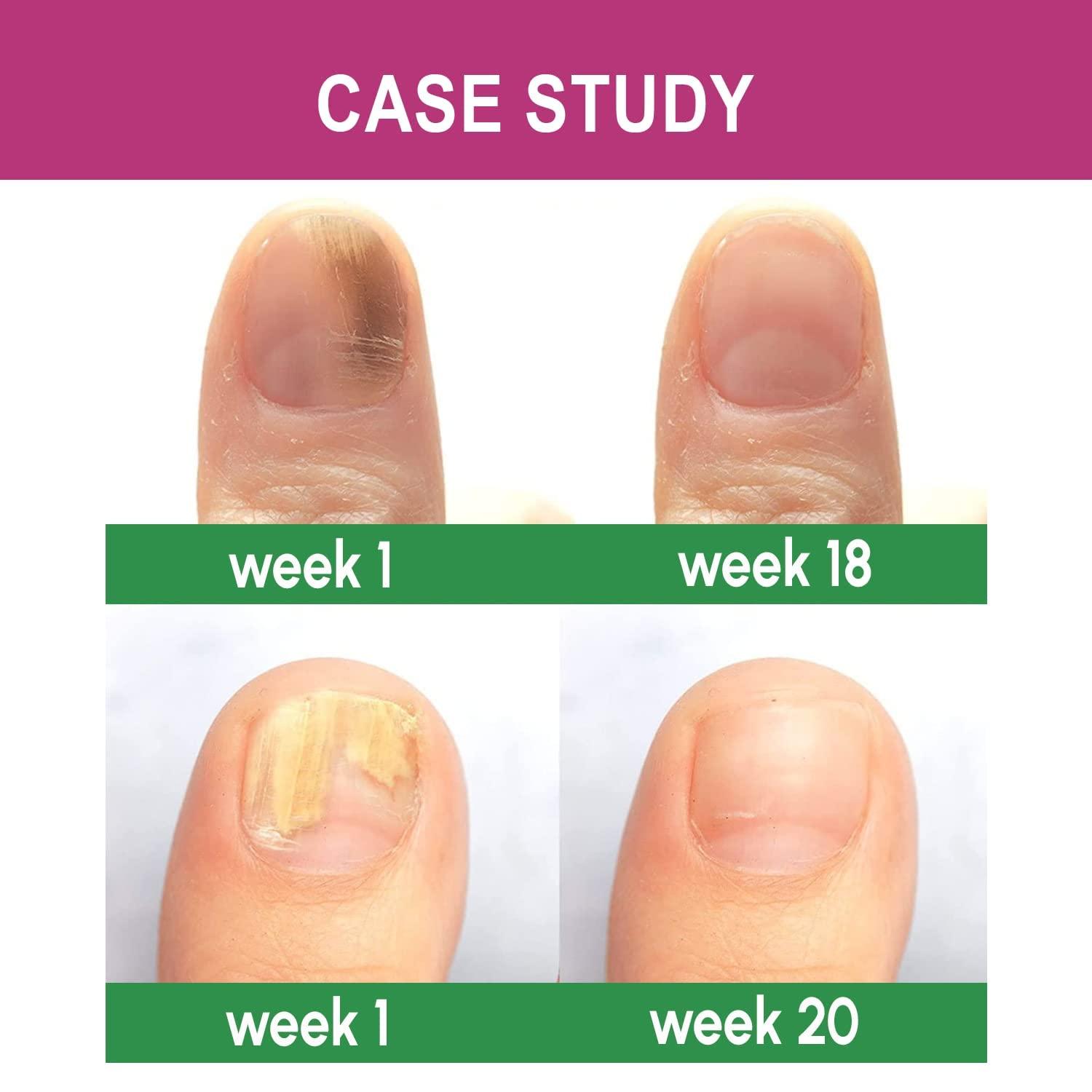 Is Nail Fungus Contagious? Preventing Toenail & Fingernail Fungus