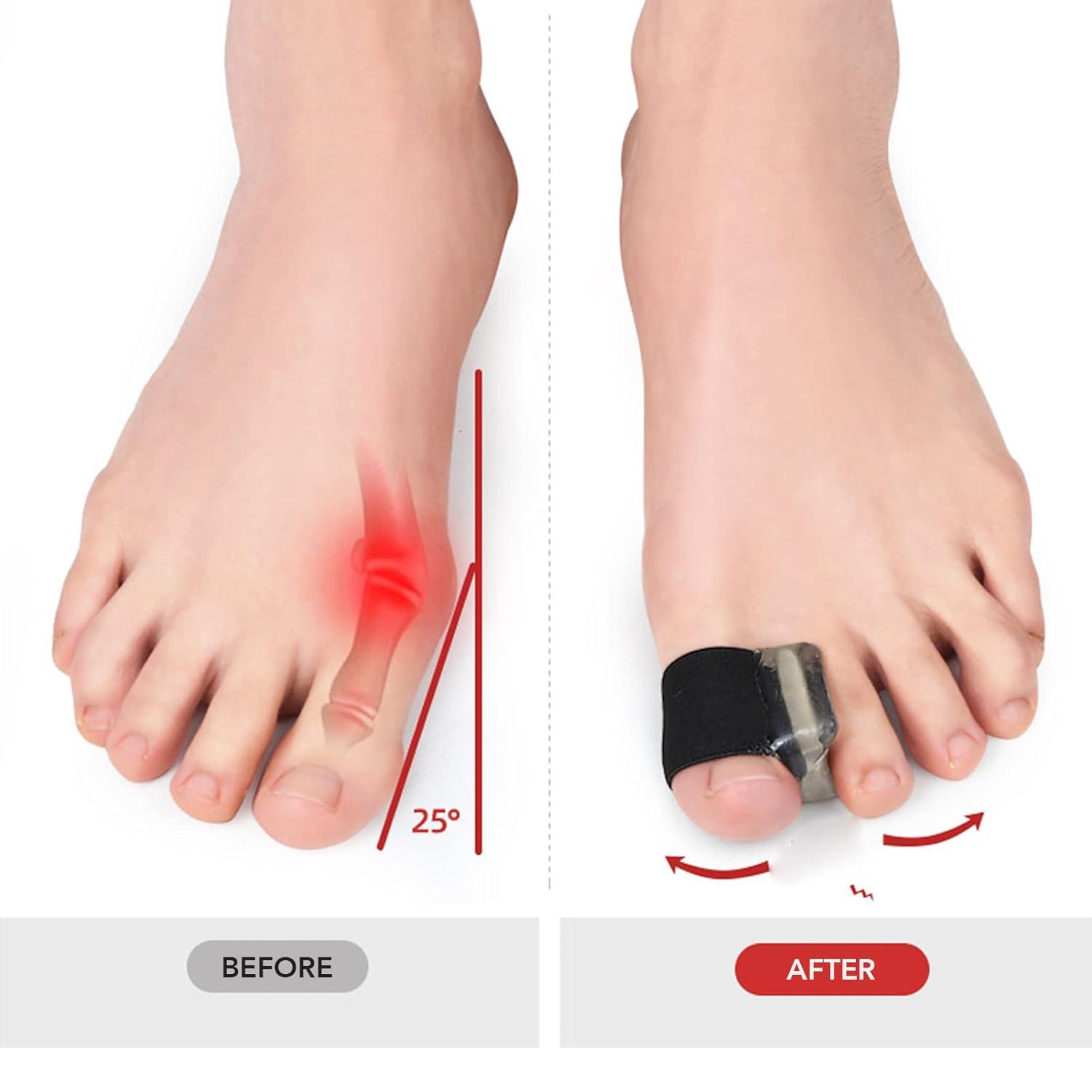 Toe Spacers Separators Prevent Friction Flexible Bunion Relief 6 Pairs