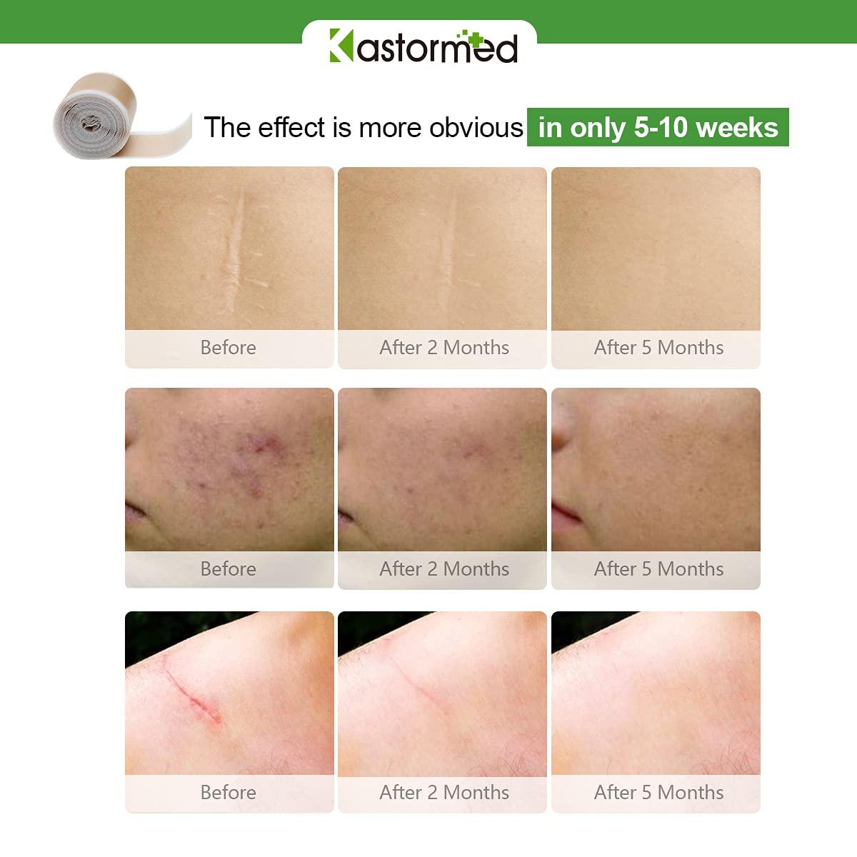 Silicone Tape for Scars, Soft Medical Tape Easy Removal for Keloid Bump