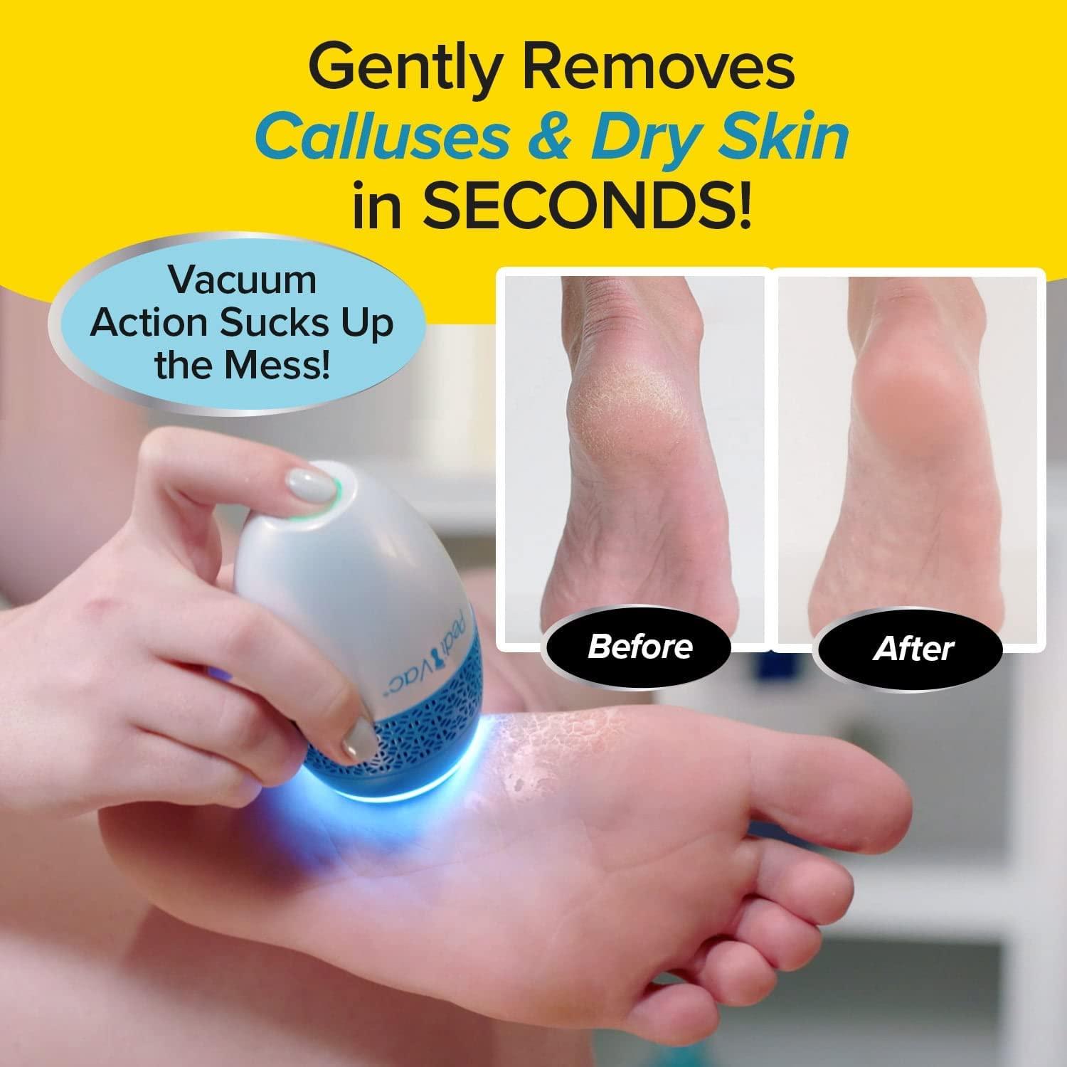 Pedi Vac by Ped Egg - Callus Remover for Feet with Built-in Vacuum Removes  Dead Skin from Feet with 2000 RPMs - Electric Callus Remover Sucks Up  Shavings for Mess-Free Exfoliation