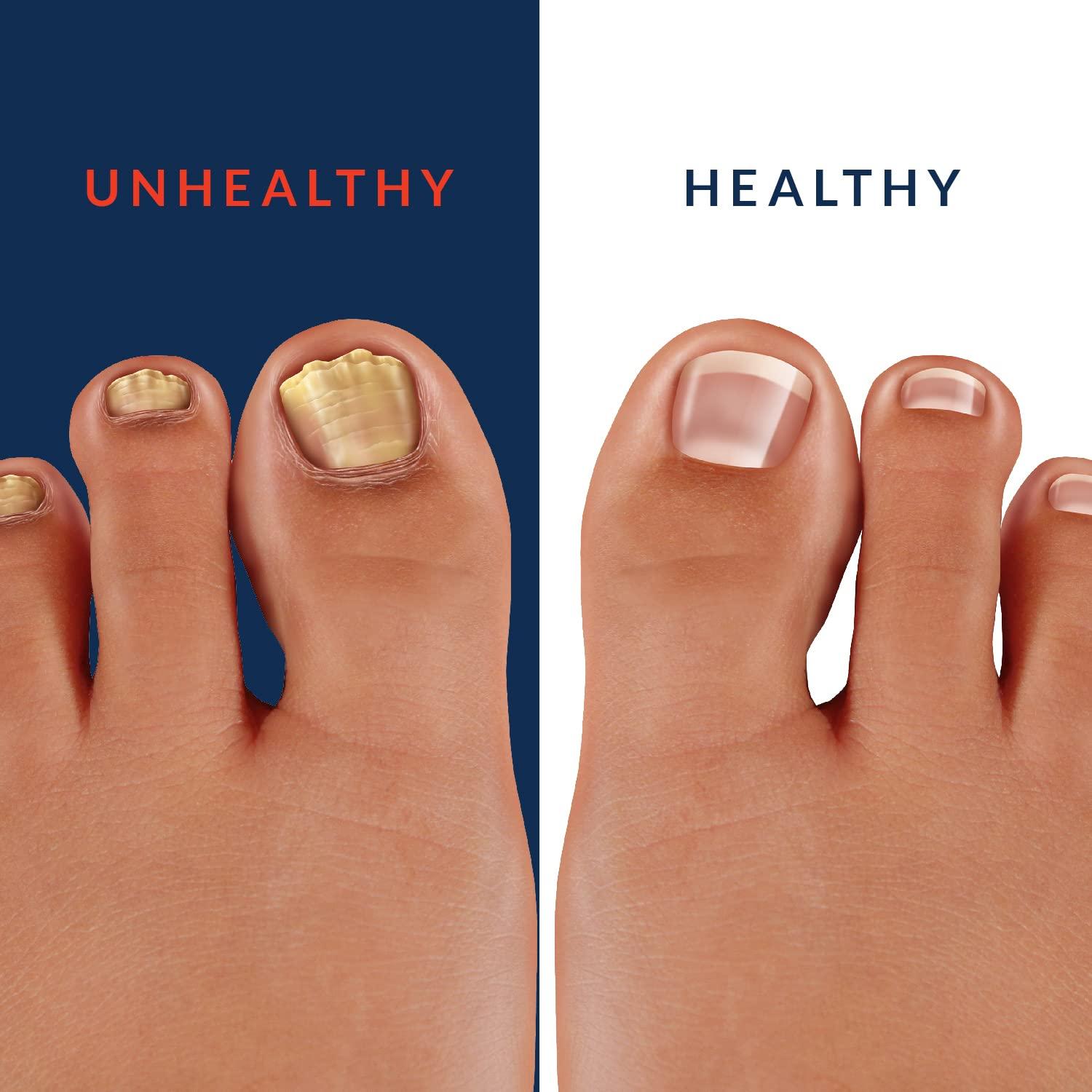 NAIL MAX AntiFungal Formula Finger and Toe Fungus Treatment, Made in