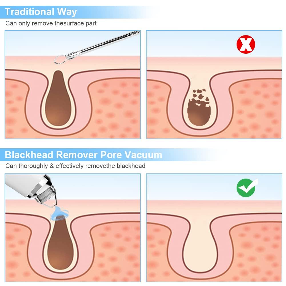 Blackhead Remover Pore Vacuum Silkwish Electric Facial Deep