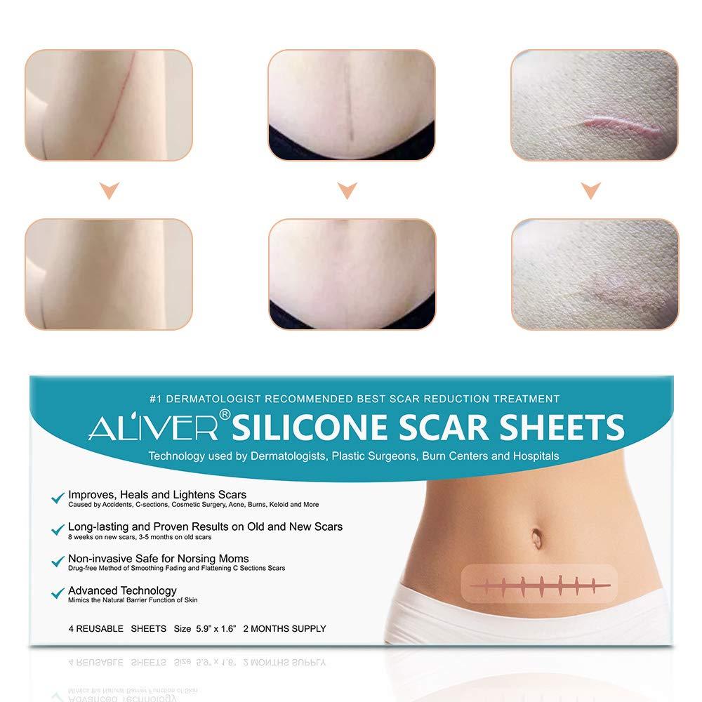 Silicone Scar Sheets, Strips, Tape - Keloid, C-Section, Surgical - Scars  Removal