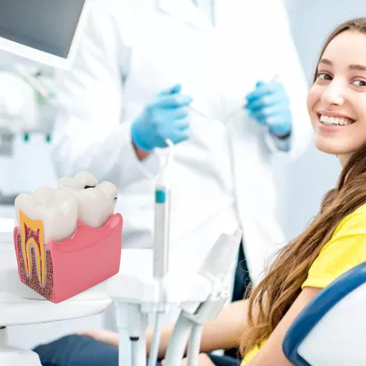 Tooth Caries Model - 6x Enlarged Caries Demonstration for Dental ...