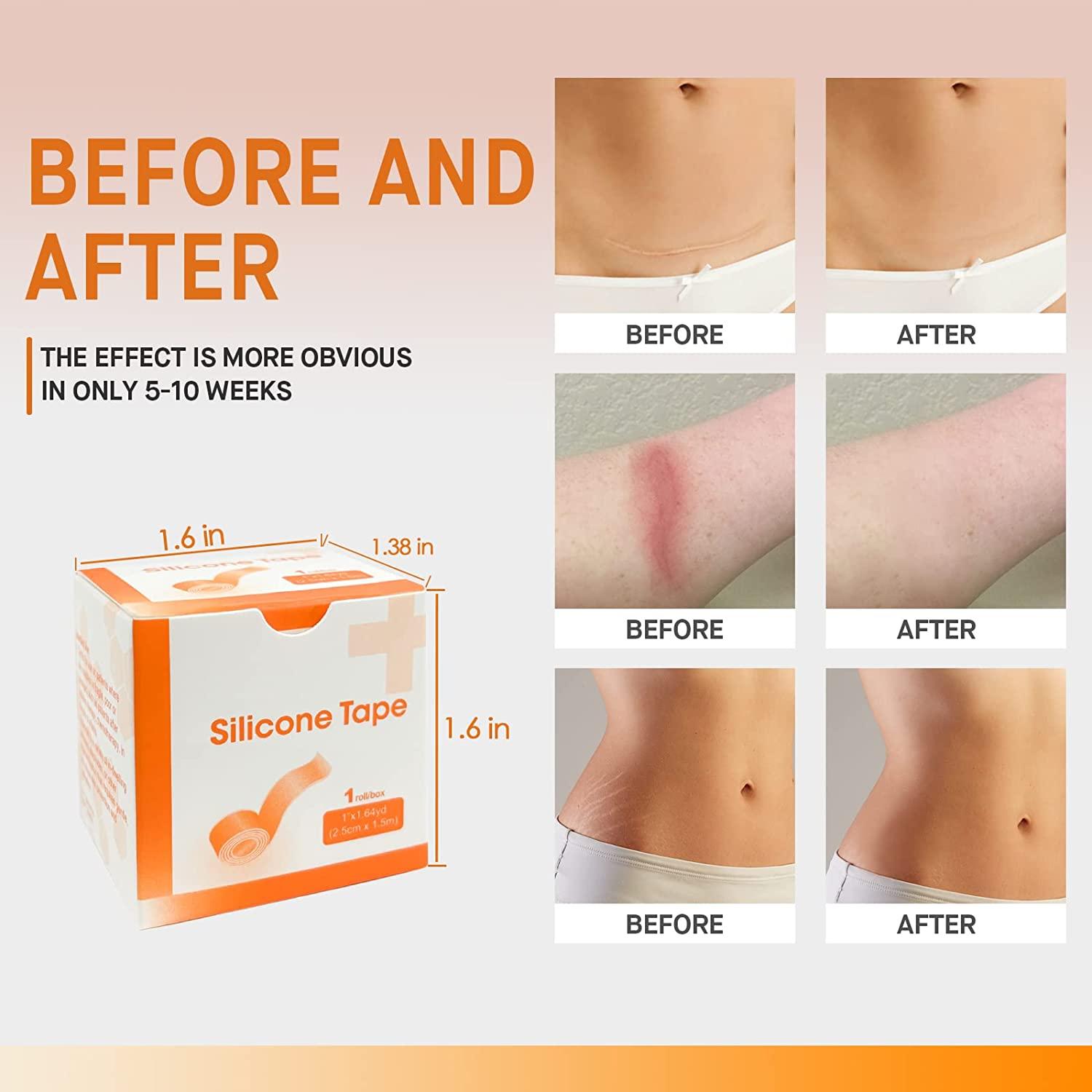 Silicone Scar Tape (1" x 60"Roll),Medical Silicone Tape for Scars