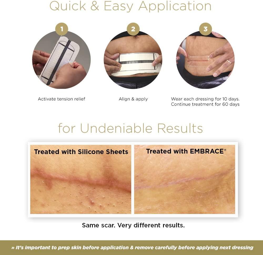 Embrace Scar Treatment Extra Large Silicone Sheets (6.3in) for New