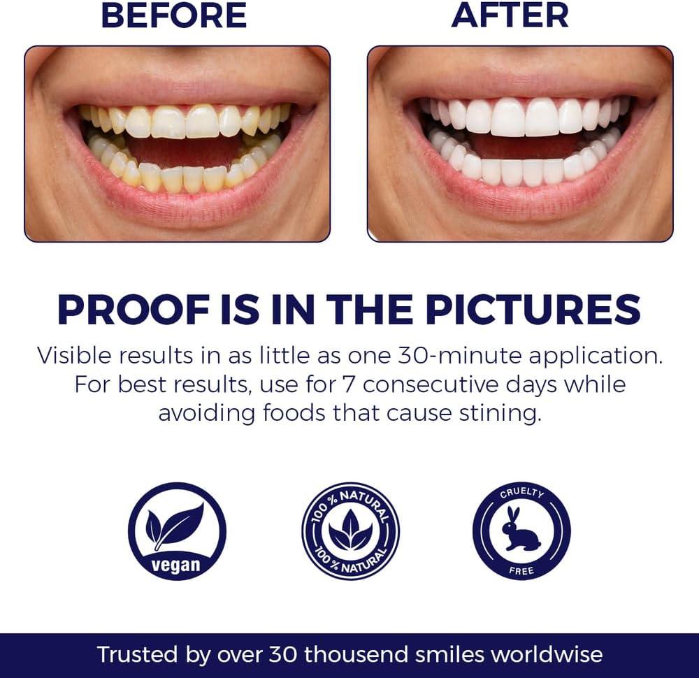 Celakeety Teeth Whitening Kit: Pap Teeth Whitener For Sensitive Teeth- Professional Tooth