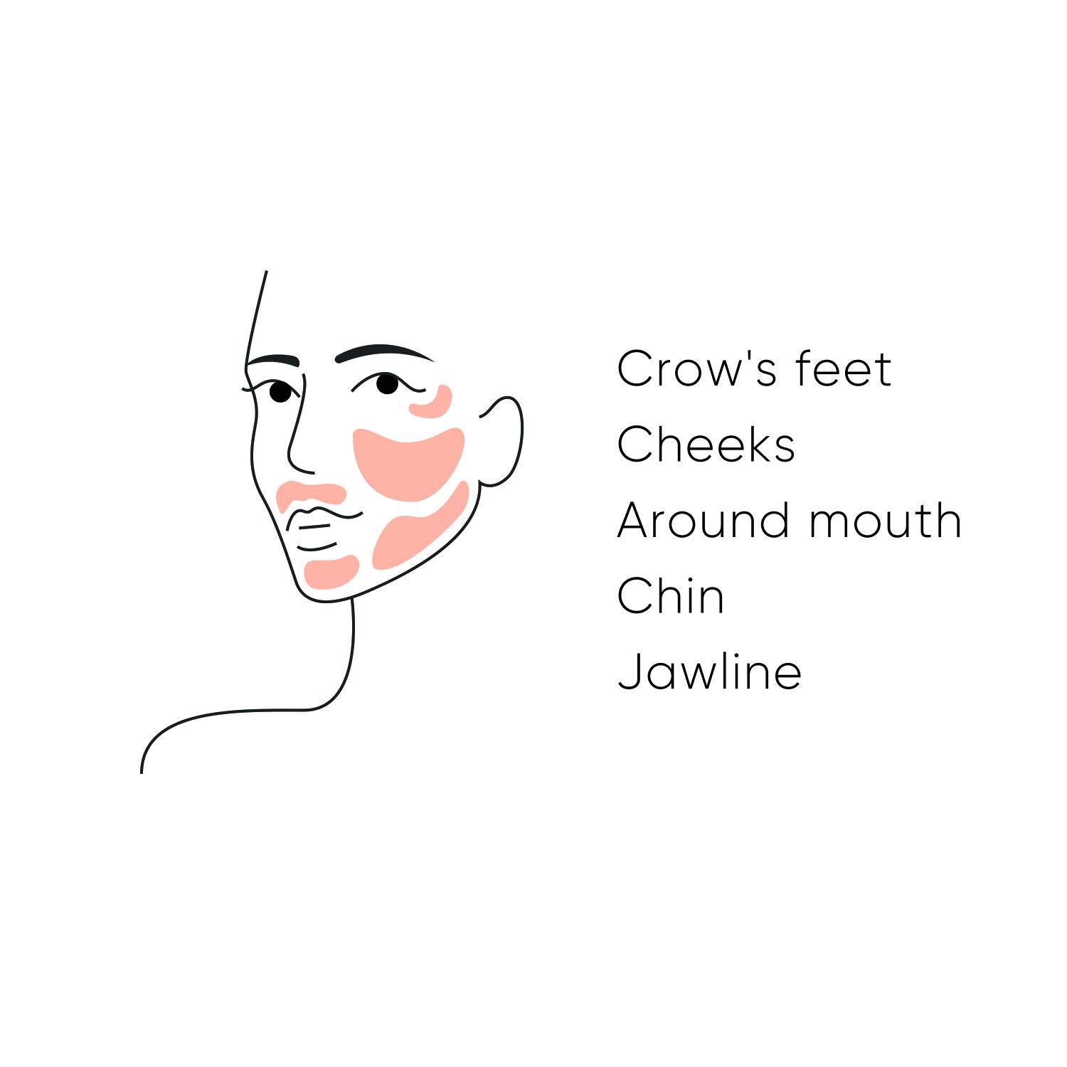 Sensilift Radio Frequency Skin Tightening Device AntiAging Kit for