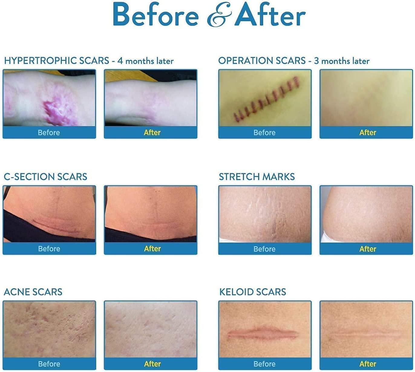 Aroamas Silicone Scar Sheets Soften & Flatten Scars from Surgery