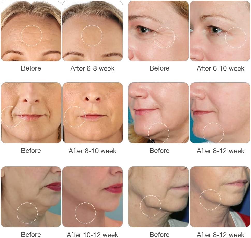 MLAY RF Skin Care Machine Professional Skin Tightening Device with 3