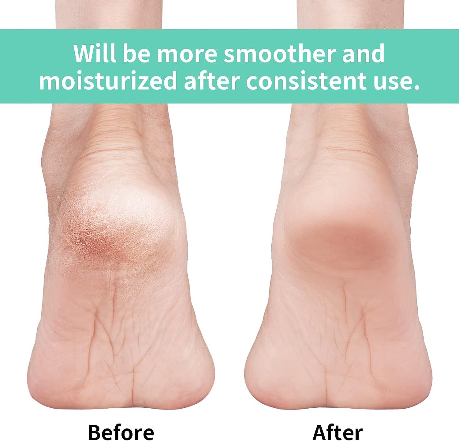 How to Fix Rough, Dry Cracked Skin on Feet - Lativ Natural Skin Revival