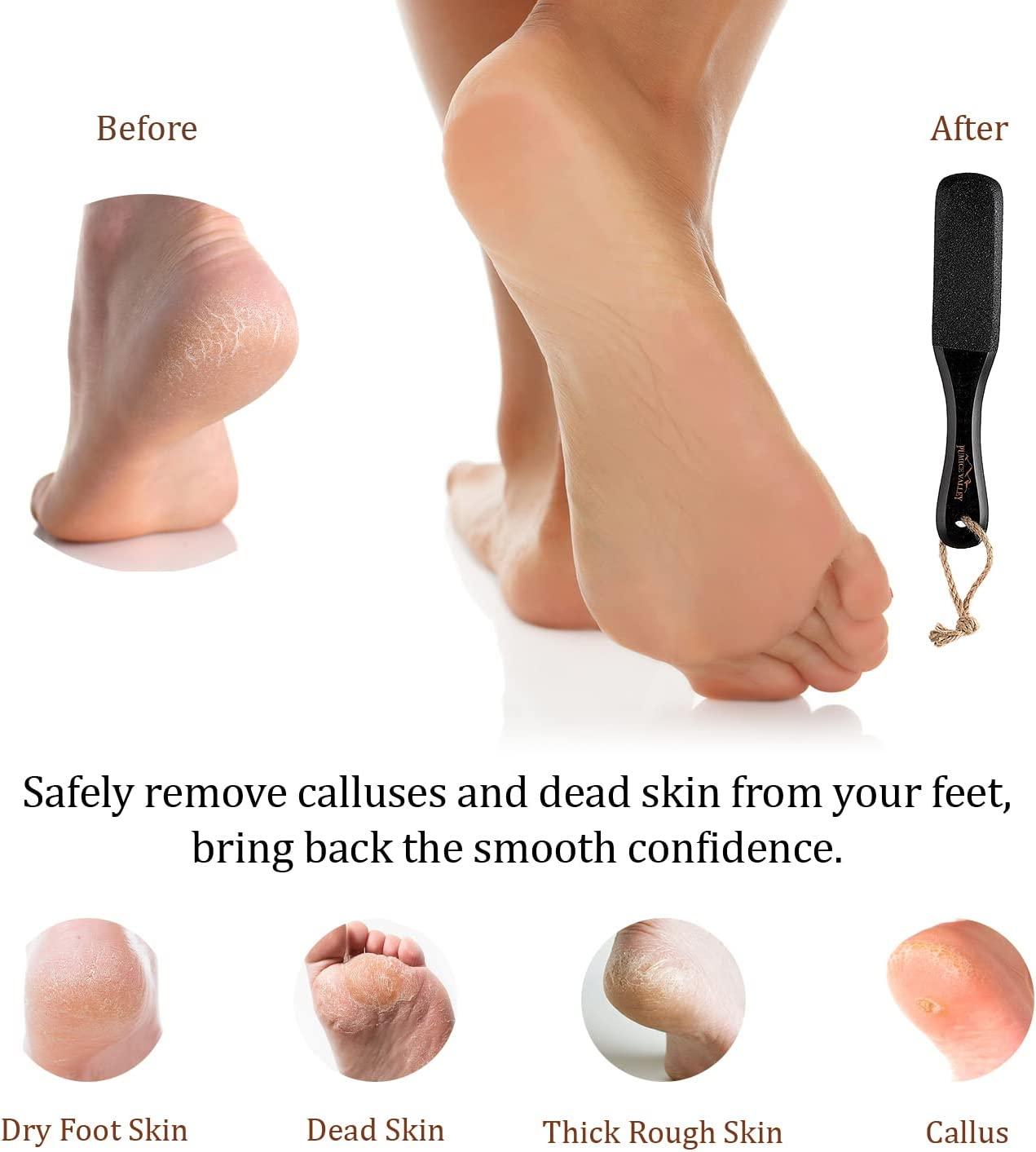 Double Sided Foot Scrubber for Dead Skin,Pedicure Tools for Feet,Foot File  for Women,Foot Cleaner Brush,Foot Scraper Callus Remover,Heel Scrubber for  Cracked Heels Safe Tool 