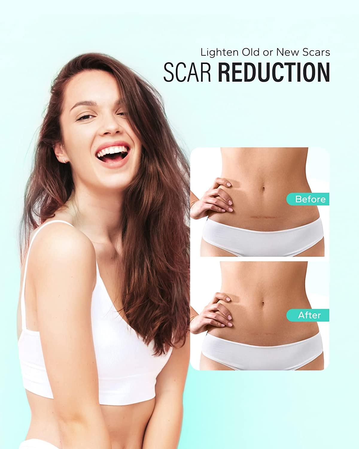 Silicone Scar Tape (1.57 * 120 Inches), Maskiss Silicone Scar Removal