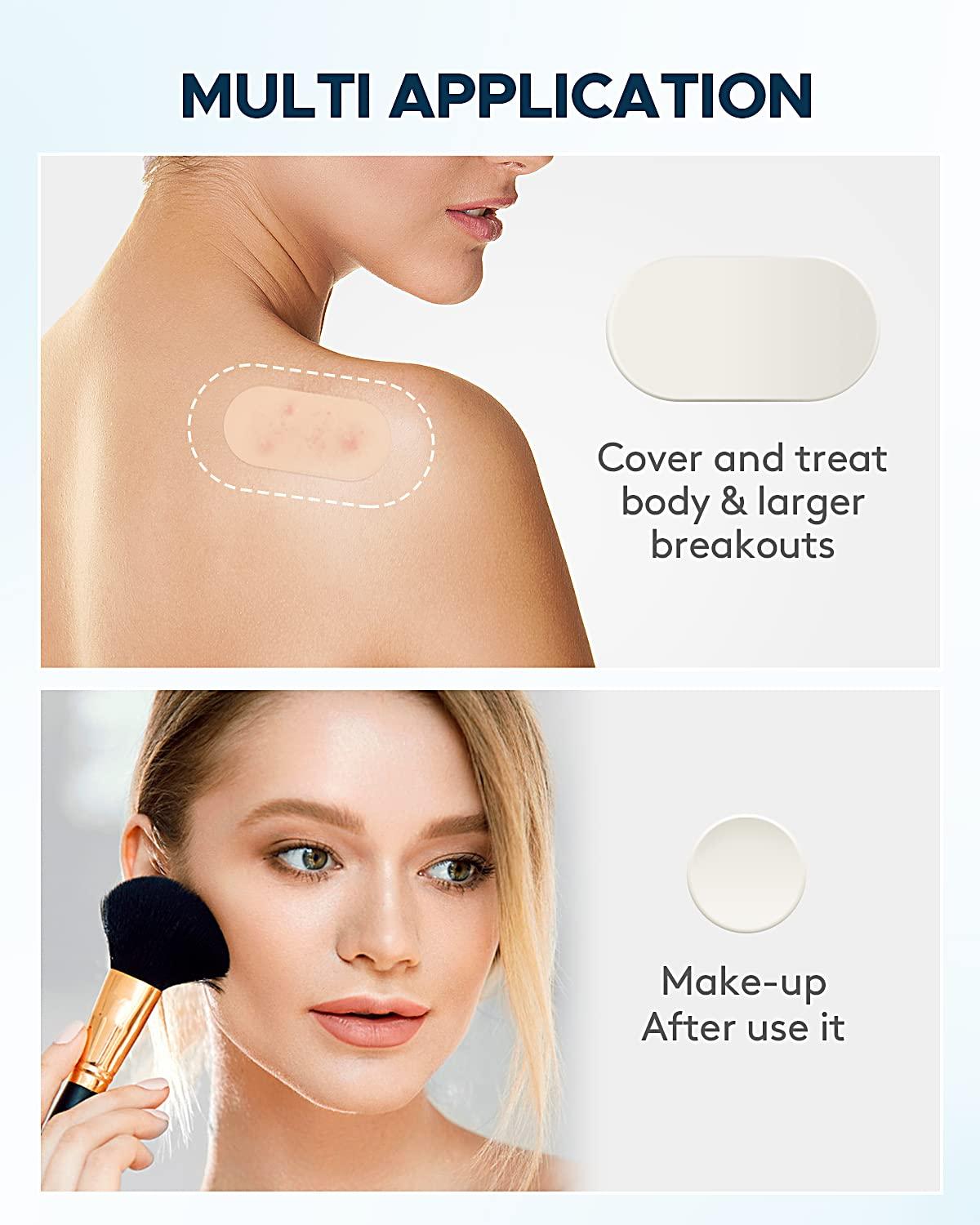 Acne Pimple Patches, 5 Sizes 80 Patches for Large Zit Breakouts